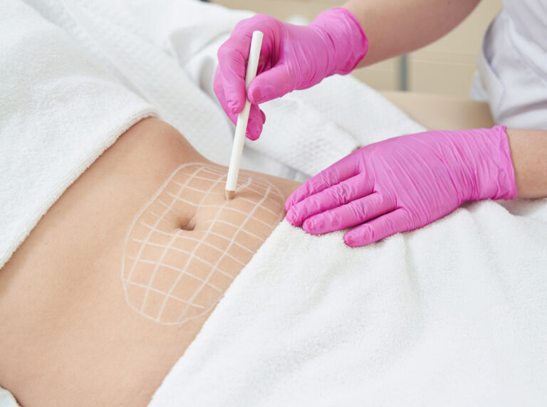 Lipofilling