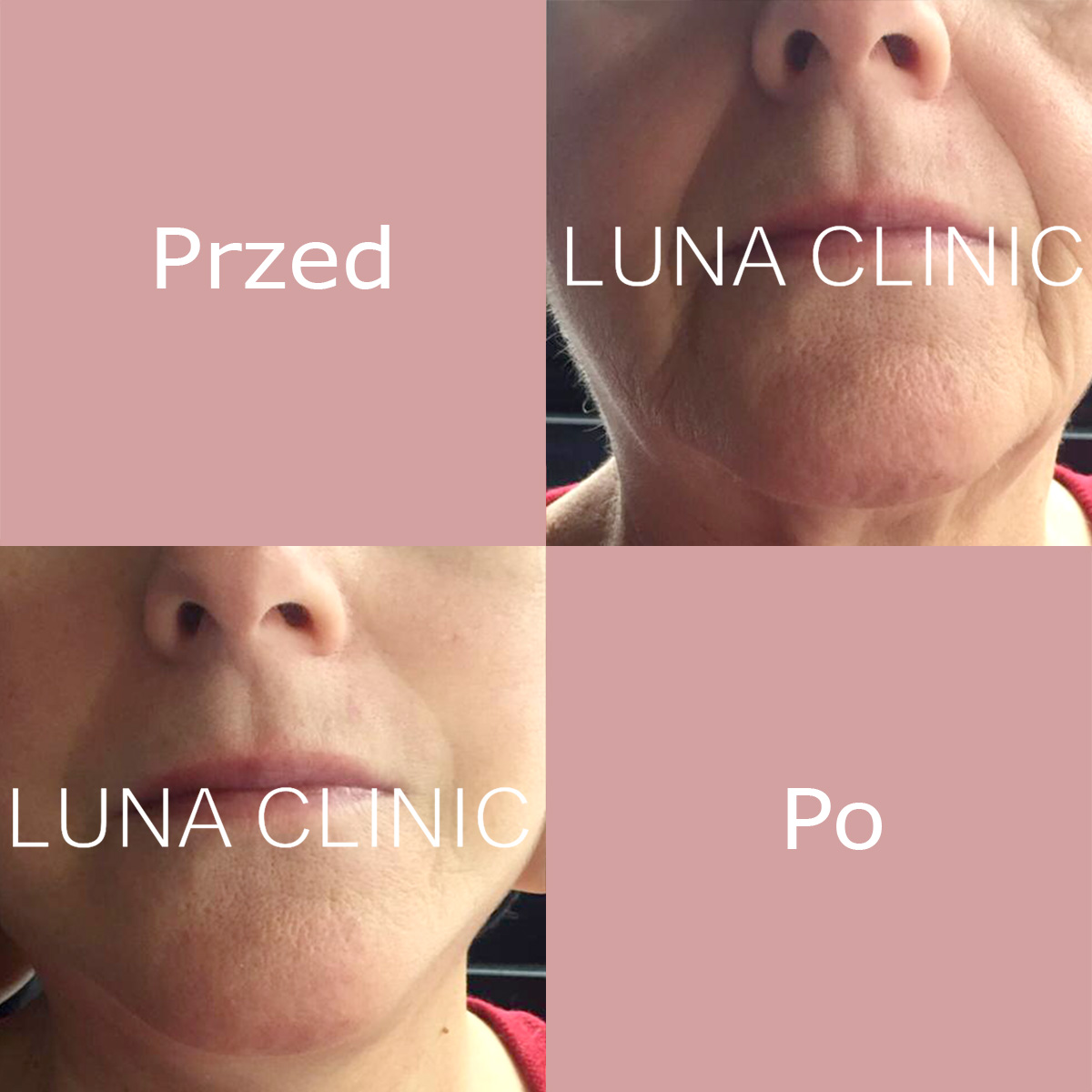 Facelift