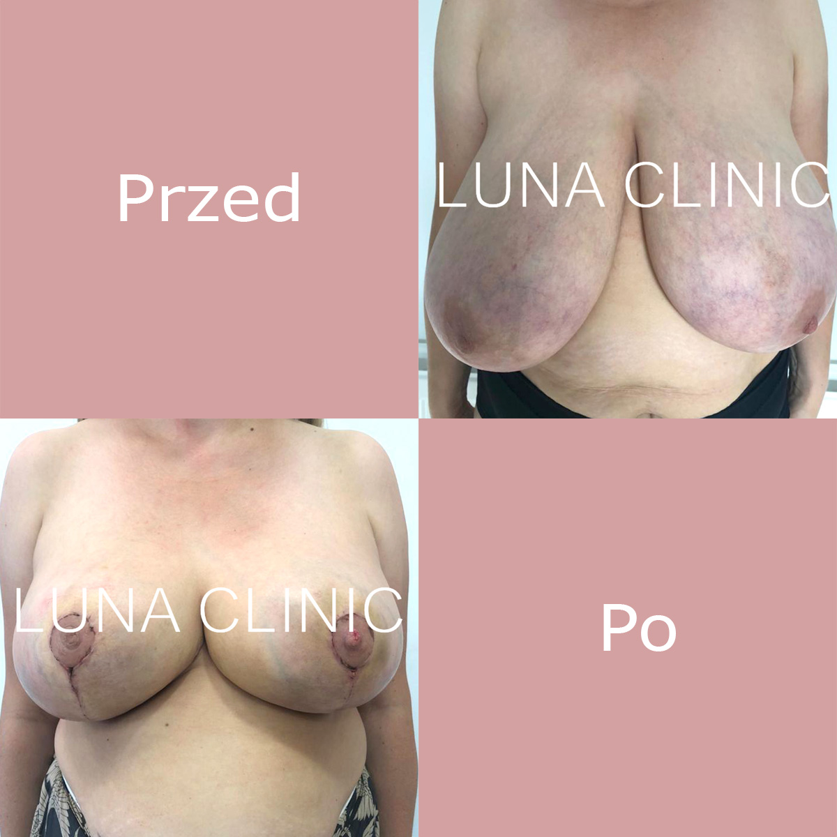 Redukcja piersi