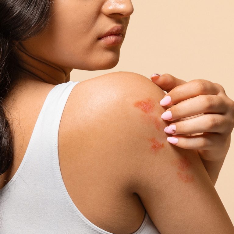 Fotografia przedstawia proces leczenia łuszczycy w gabinecie dermatologicznym. Dermatolog aplikuje specjalistyczny preparat na zmienione chorobowo miejsca na skórze pacjenta. Zdjęcie ukazuje sterylne warunki oraz nowoczesne metody terapeutyczne, takie jak fototerapia lub leczenie farmakologiczne.