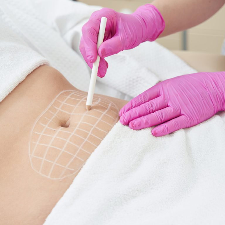 Lipofilling