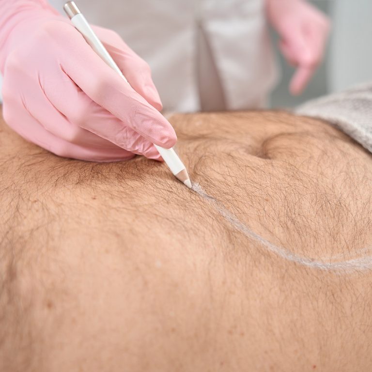 medycyna-estetyczna-wroclaw-lipofilling-1.jpg